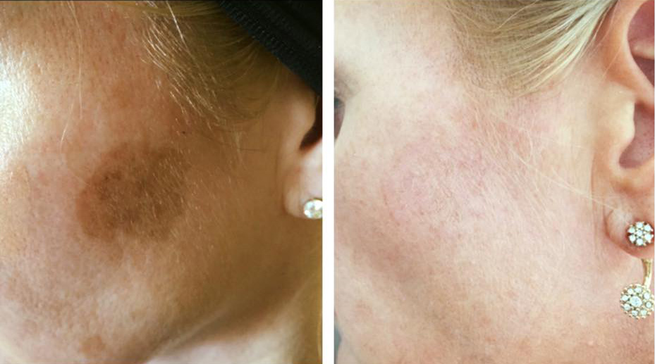 Tocolo cryotherapy blemish before and after